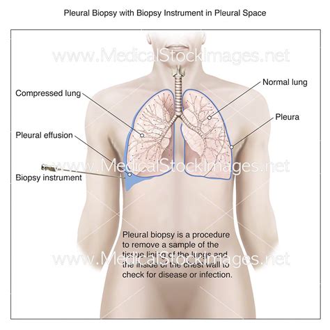 Pleural Biopsy with Instrument in Pleural Space – Medical Stock Images Company