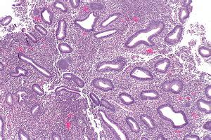 Disordered proliferative endometrium - Libre Pathology