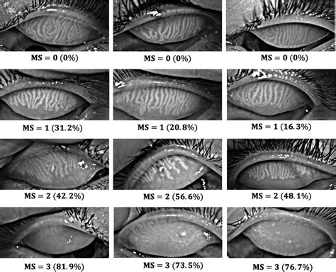 Meibography images with ground-truth percent atrophy (%) and ...