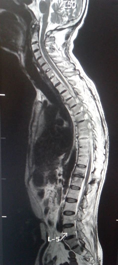 Ankylosing Spondylitis: MRI - Sumer's Radiology Blog