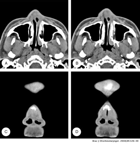 Iatrogenic nasal vestibular stenosis after maxillofacial reconstructive ...