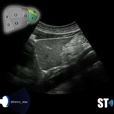 Couinaud’s Liver Segments – Sonographic Tendencies