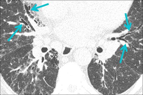 HRCT Scan Gallery | Insights in ILD