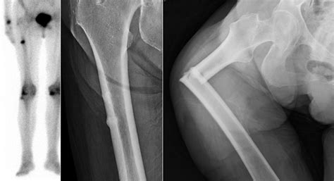 Atypical femur fractures