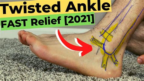 High Ankle Sprain Recovery Time: *The Best Treatment Guide!*