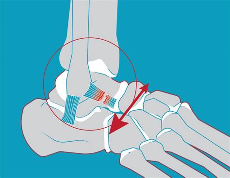 Chronic Ankle Pain And Inflammation Following Atfl Rupture