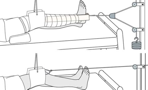 Bucks Traction:A Comprehensive Guide