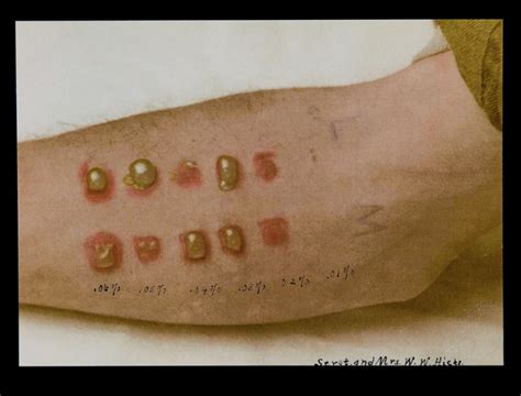 The Dead Of Flanders Fields — A skin spot test with mustard gas. The numbers...