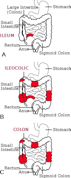 Download The Three Most Common Sites Of Intestinal Involvement - Chrome Disease - Full Size PNG ...