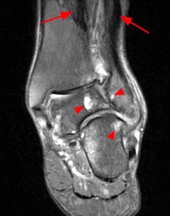 Lateral Hindfoot Impingement | Radsource