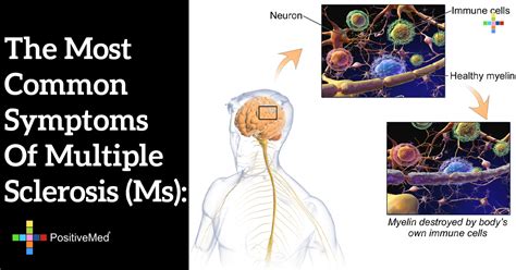 The most common symptoms of multiple sclerosis (MS): - PositiveMed