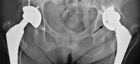 Revision Total Hip Replacement - OrthoInfo - AAOS