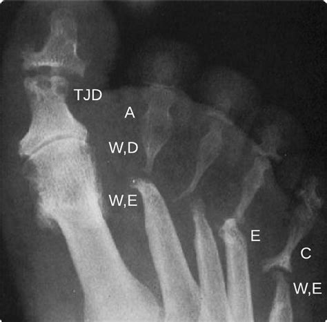 Psoriatic Arthritis Mutilans: Clinical and Radiographic Criteria. A Systematic Review | The ...