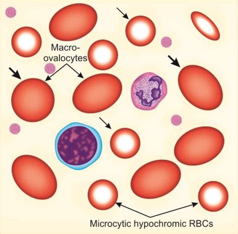 Megaloblastic Anemia Peripheral Smear