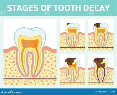 Pulpitis And Healthy Tooth Vector Illustration | CartoonDealer.com #56416784