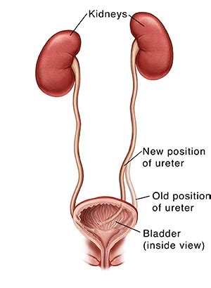 Ureteral Reimplantation Surgery | Saint Luke's Health System