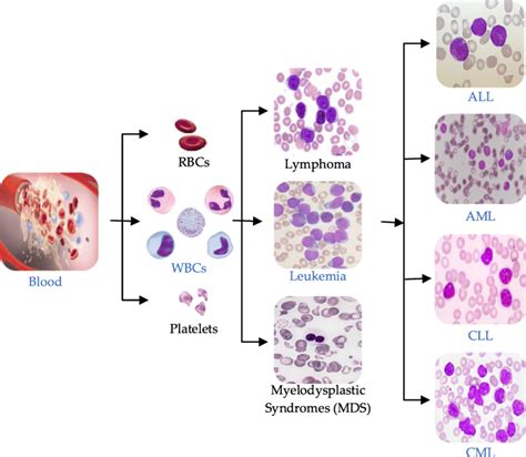 Blood components and main types of leukemia | Download Scientific Diagram