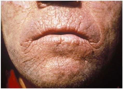 7 Rarest Skin Diseases in the World - Rarest.org