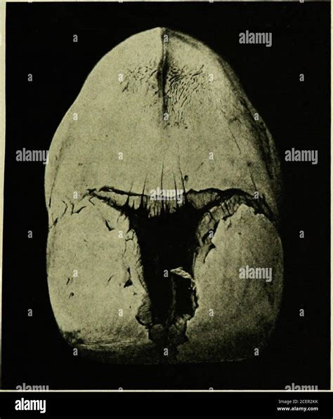 Condition cretinism hi-res stock photography and images - Alamy