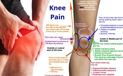 Knee pain Homeopathic treatment Right knee Left Knee by Dr Makkar