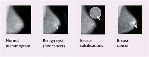 8 pictures to help you determine if a breast lump is cause for concern