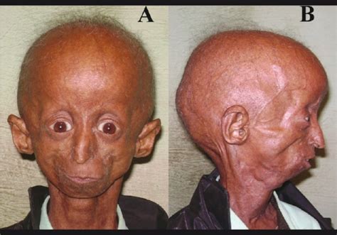 External photograph of a 15-year-old Hutchinson-Guilford progeria male... | Download Scientific ...