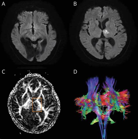 Internuclear Ophthalmoplegia Mri