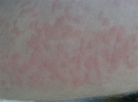 cold urticaria pictures - pictures, photos