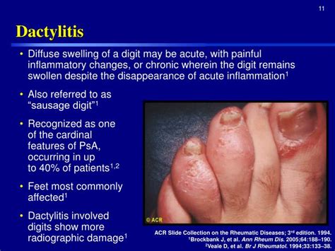 PPT - Psoriatic Arthritis PowerPoint Presentation - ID:2330566