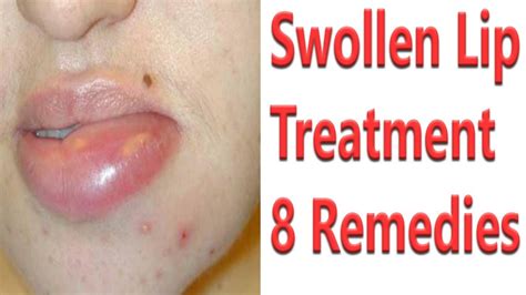 8 Best Remedies For Swollen Lip Treatment | How To Get Rid Of Swollen ...