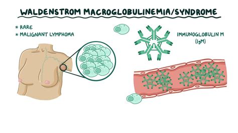 Waldenstrom macroglobulinemia: Video & Anatomy | Osmosis