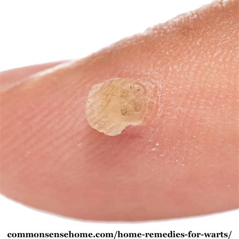 Planters Wart On Hand Removal | Bruin Blog