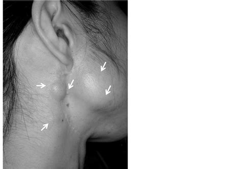 A Case of Pleomorphic Adenoma of the Parotid Gland with Multiple Local Recurrences through ...