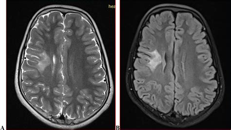 Twelve year old male with epilepsy brain axial MRI (T2/FLAIR) (A and B... | Download Scientific ...