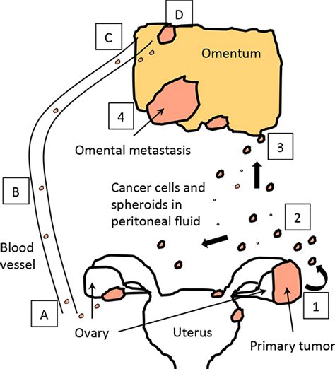 Ovarian cancer metastasis to liver life expectancy | doctorvisit