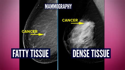 Do you have dense breasts? You may need more than a mammogram - TODAY.com