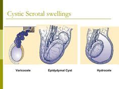 Hydrocele - Vericocele Disorder