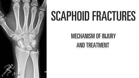 Scaphoid Fracture