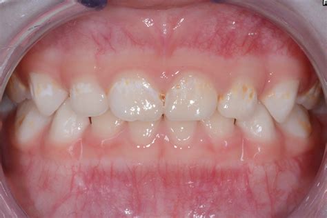 Early Childhood Caries Symptoms: White Spot Lesions, Tooth Decay, Pain, Swelling, Eating or ...