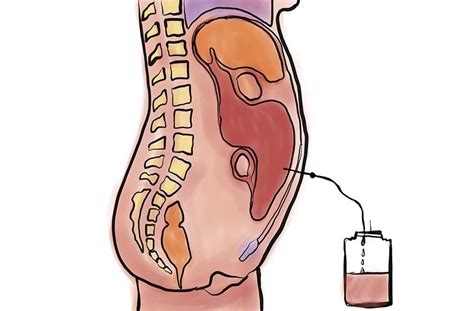 Peritoneal Mesothelioma | Treatment, Prognosis & Diagnosis ...