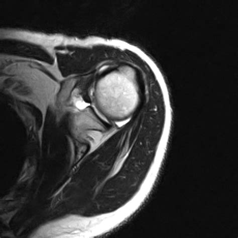 Buford Complex-Normal Variant - Sumer's Radiology Blog