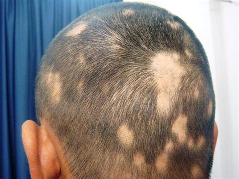 Alopecia Areata