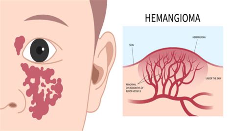 What Is Cherry Angioma? Causes, Symptoms, Risk Factors, and More | Skin Cancer Specialists