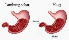 Pin di Cara Mengatasi Asam Lambung Yang Tinggi