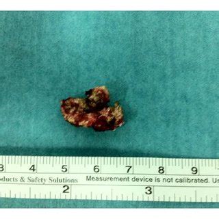 Surgical excision of the tophi in the penis. | Download Scientific Diagram