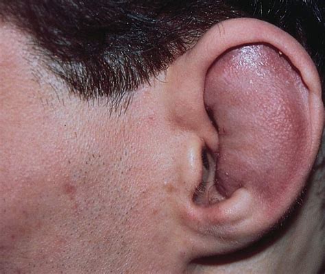 Study Medical Photos: External Ear Injuries - Brief Description With Pictures.