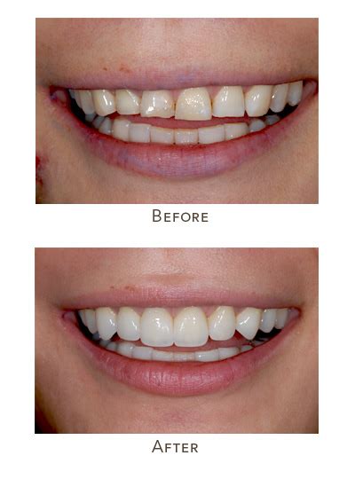 How to fix different sized teeth | Treat Uneven teeth length of front incisors