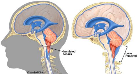 Tonsils Of Cerebellum