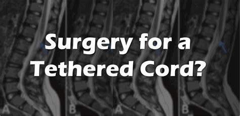 Surgery for Tethered Cord in Adults? - Regenexx