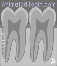 How to read dental x-rays- What do cavities look like? | Stages